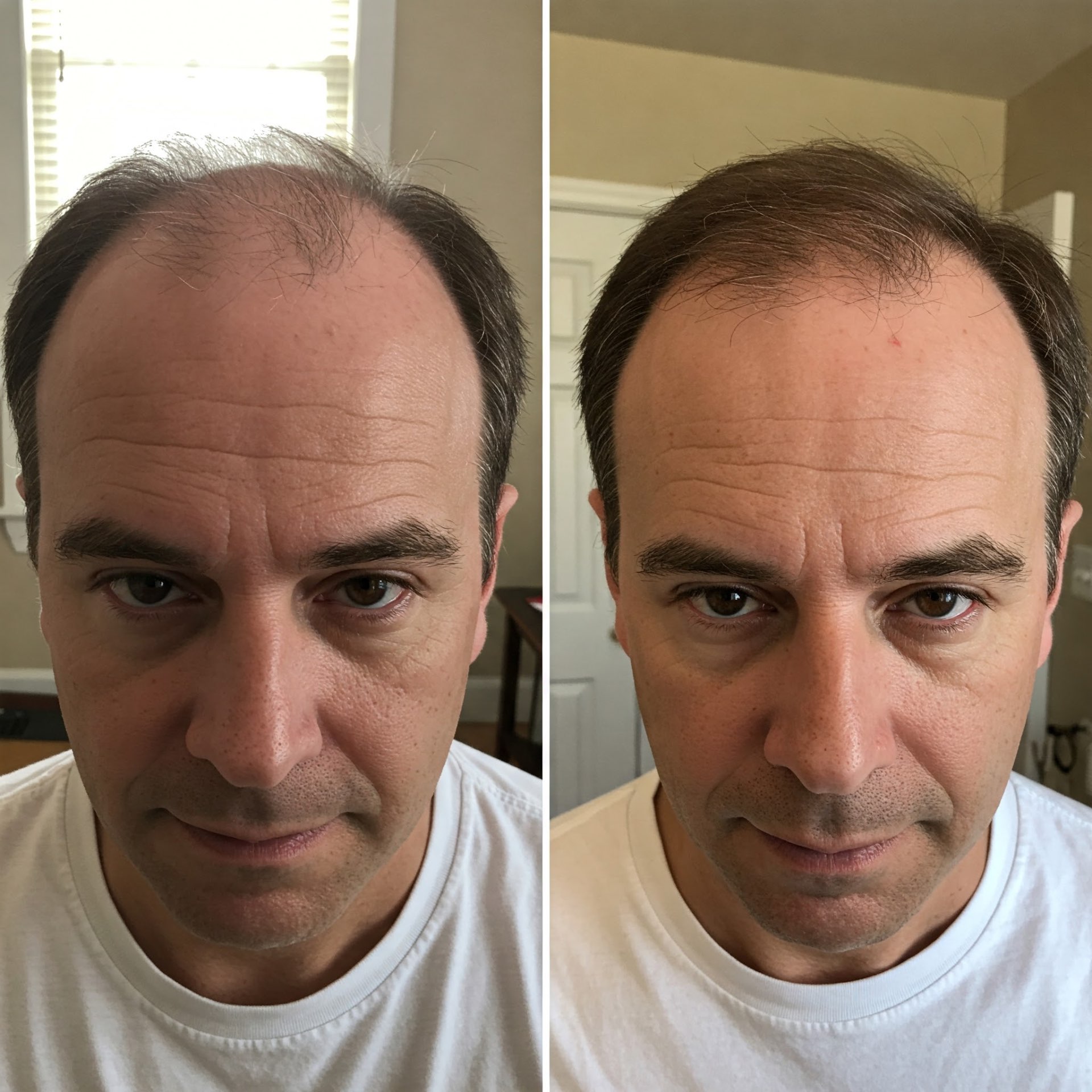 Facial dark spots improvement before and after light therapy