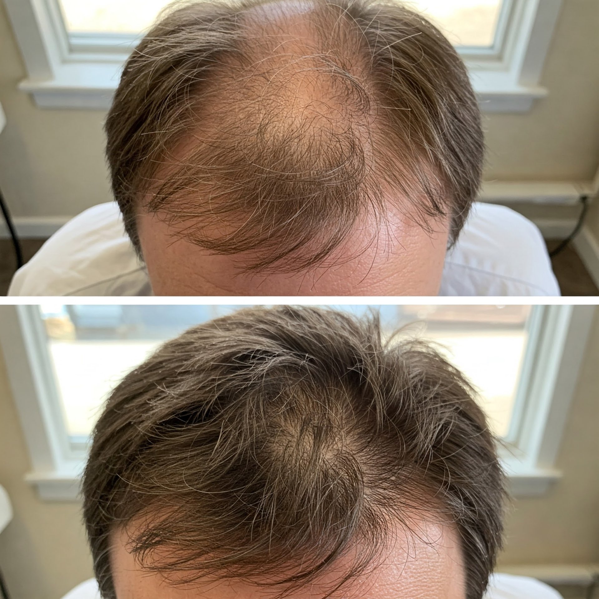 Male facial rejuvenation before and after light therapy