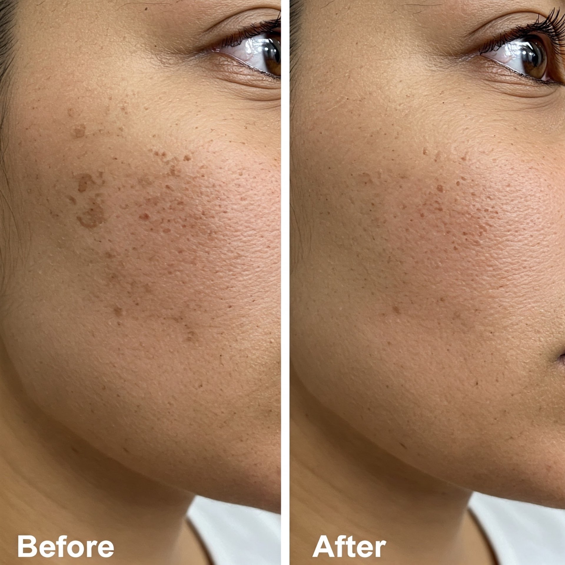 Skin texture improvement before and after light therapy