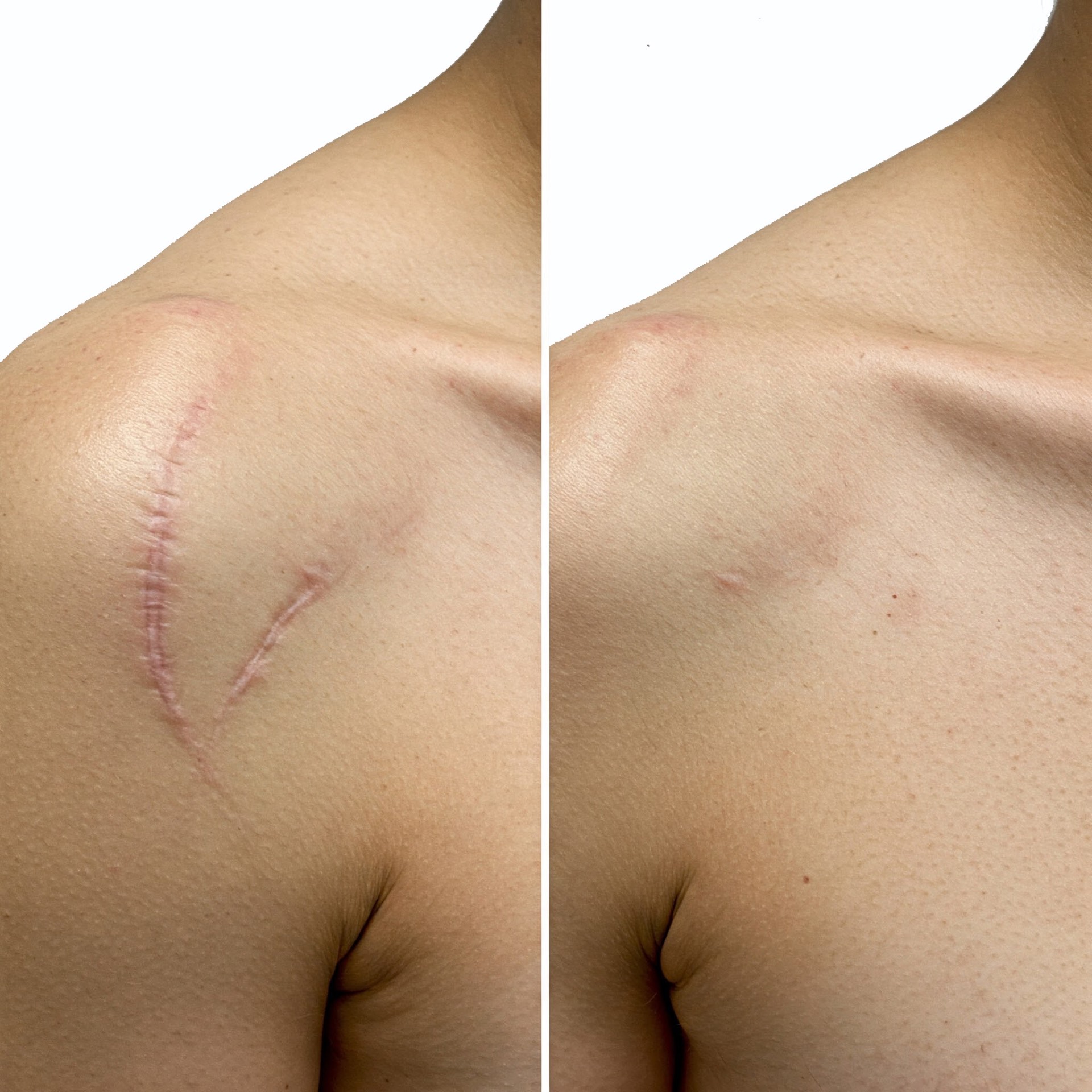Scar reduction before and after light therapy